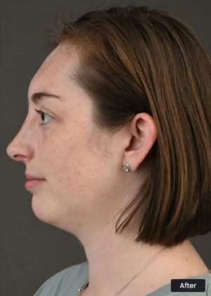 6 Months After Rhinoplasty Sydney