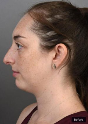 Rhinoplasty Sydney