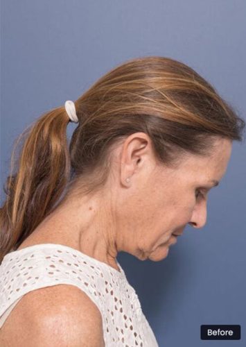 Profile View Before Face and Neck Lift Sydney