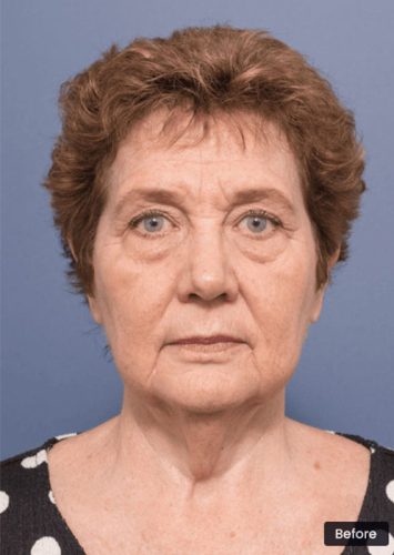 Face and Neck Lift Sydney