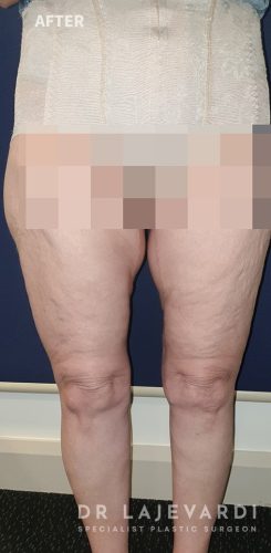 6 Months After Thigh Lift Sydney