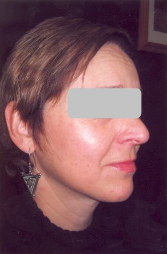 Face and Neck Lift Sydney