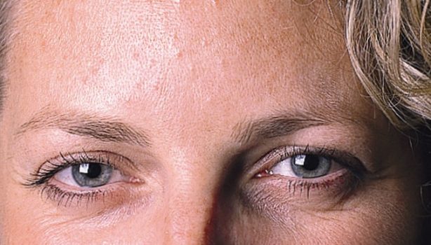 4 Weeks After Anti-Wrinkle Injections