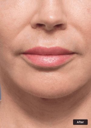 3 Months After Lip Lift Surgery