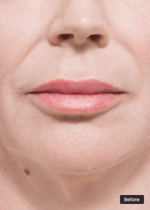 Lip Lift Surgery