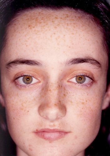 (Image 1) Facial Freckling Before Medium Chemical Peel