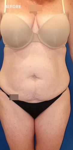 Tummy Tuck Sydney