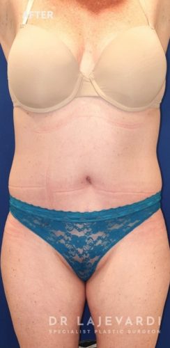 Abdominoplasty Sydney