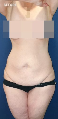 Body Lift Surgery