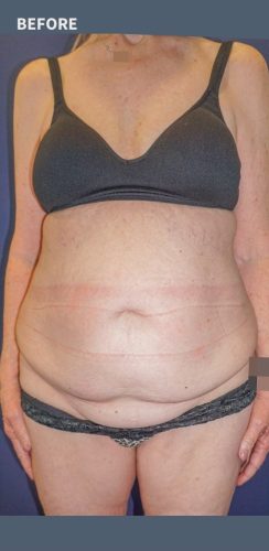 Tummy Tuck Surgery