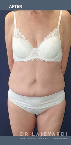 12 Months after Body Contouring Surgery