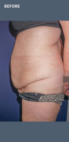 Abdominoplasty Sydney