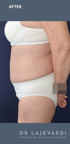 Tummy Tuck Surgery