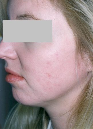 Acne Treatment Sydney