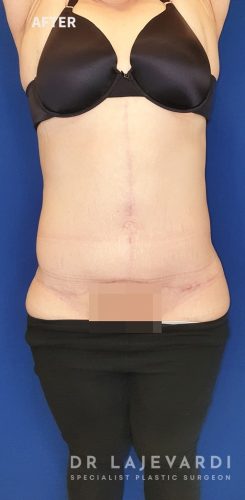 Case 1: Fleur-de-lis abdominoplasty – PlastSurgeon