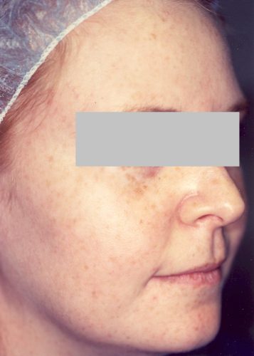 Facial Freckling Before Medium Chemical Peel
