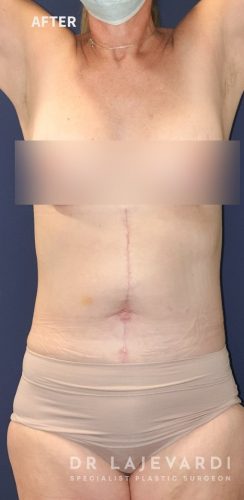 Modal Tummy Tuck Without Marks Panties Women High Waist Flat Angle