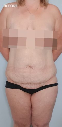 Before Tummy Tuck Surgery