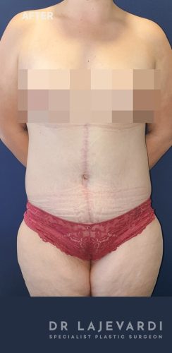 3 Months After Tummy Tuck Sydney