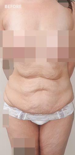 Before Corset Tummy Tuck Sydney