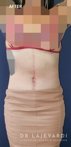 3 Months After Corset Tummy Tuck Sydney