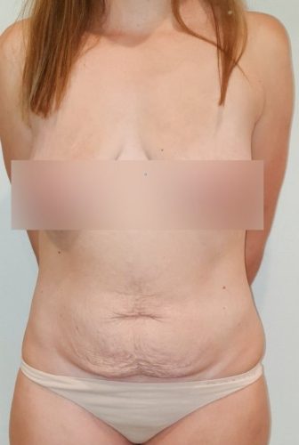 Tummy Tuck Sydney