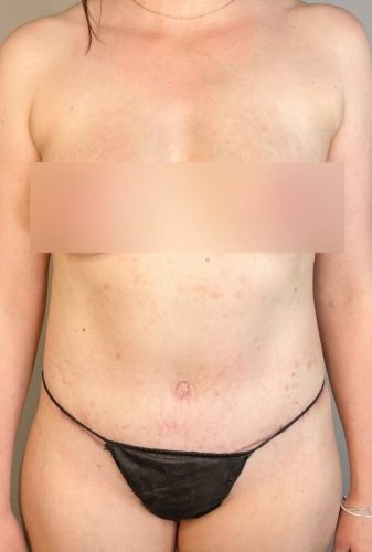 Abdominoplasty Sydney