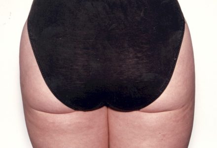 Tumescent Liposuction Sydney