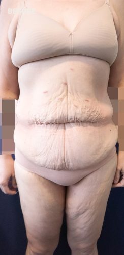 Before Corset Abdominoplasty Sydney