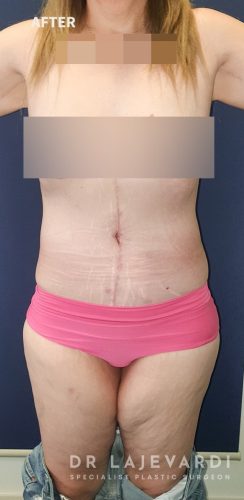 6 Months After Corset Abdominoplasty Sydney