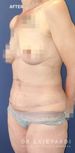 6 Months After Corset Tummy Tuck Sydney