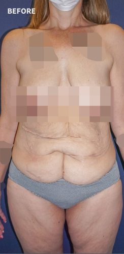 Before Corset Tummy Tuck Sydney