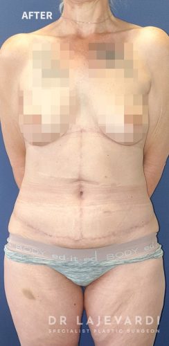 6 Months After Corset Tummy Tuck Sydney