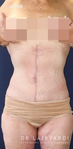 3 Months After Tummy Tuck Surgery