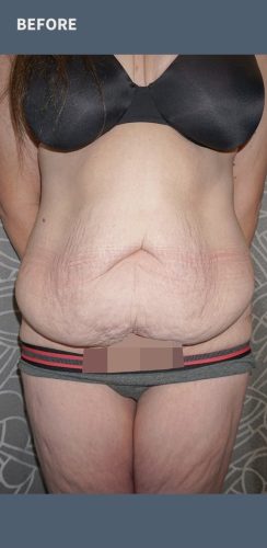 Before Abdominoplasty Surgery