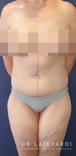 6 Months after Abdominoplasty Surgery