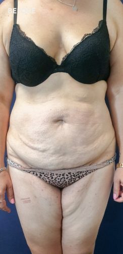 Before Corset Tummy Tuck Surgery