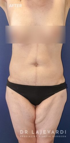 6 Months After Corset Tummy Tuck Surgery