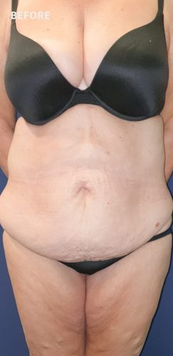 Before Abdominoplasty Sydney