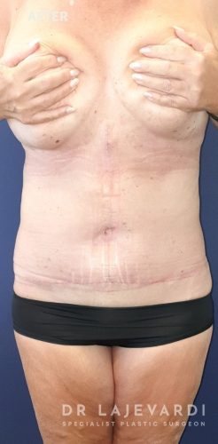 6 Weeks After Abdominoplasty Sydney