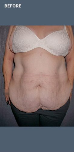 Before Abdominoplasty Sydney