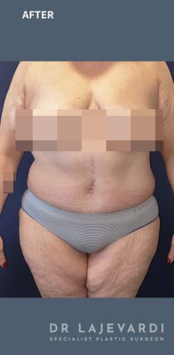 3 Years After Abdominoplasty Sydney