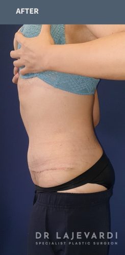 Tummy Tuck Sydney