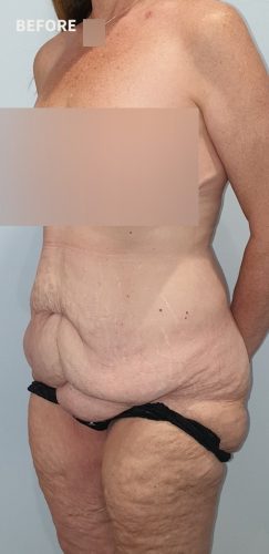 Before Corset Tummy Tuck Surgery