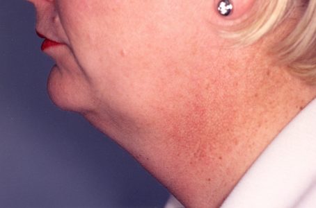 Chin Liposuction