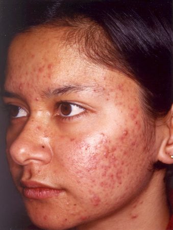 Before Acne Treatment