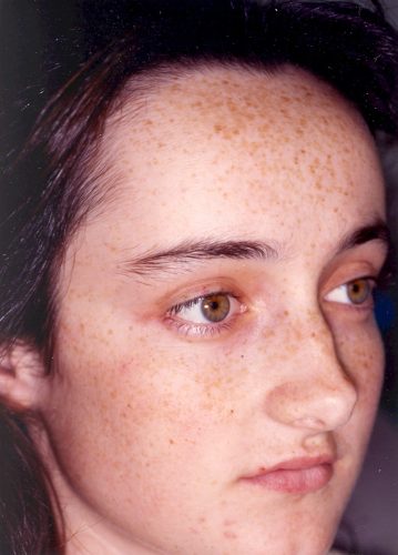 Facial Freckling Before Medium Chemical Peel