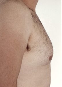 Gynecomastia Surgery