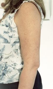 4 Months After Liposuction On Arms