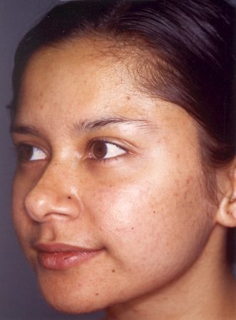 After Acne Treatment